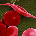 Breakthrough Sickle Cell Disease Gene Therapies Approved By FDA