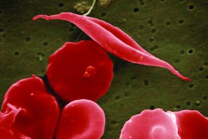 Breakthrough Sickle Cell Disease Gene Therapies Approved By FDA