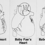 October 26, Newborn receives baboon heart in experimental transplant