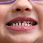 FDA restricts use of kids' fluoride supplements