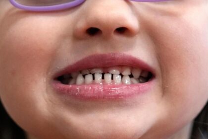 FDA restricts use of kids' fluoride supplements